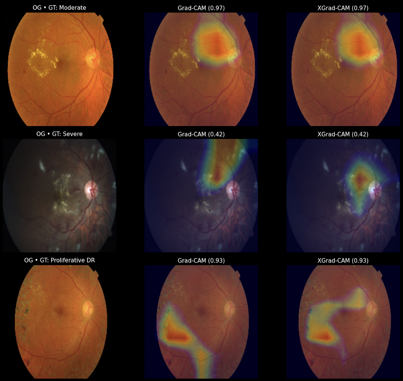 DR 분류 모델의 Grad-CAM / XGrad-CAM 시각화 예시
